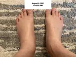 Foot Swelling photo 1