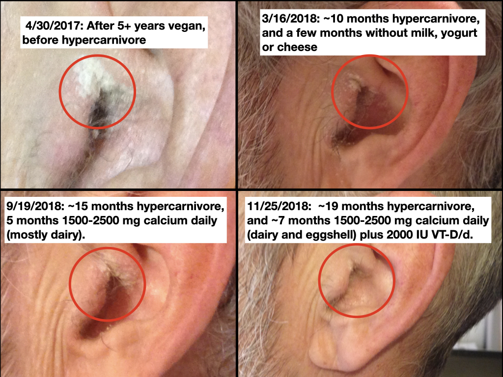 Psoriasis during hypercarnivore daze