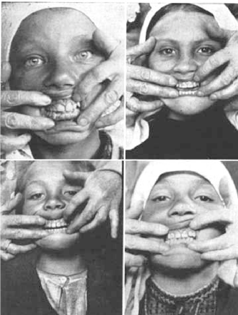 Lotschental girls from NPD Weston Price Lotschental girls from NPD Weston Price