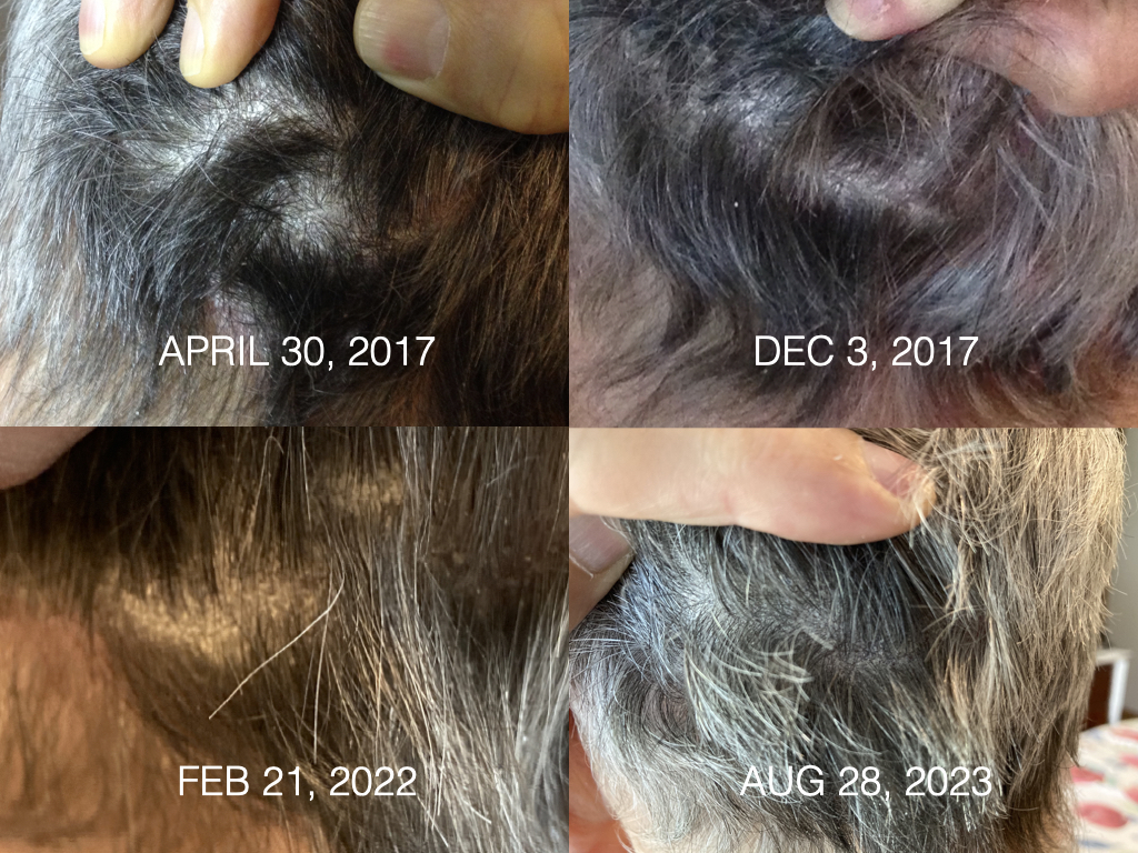 Scalp psoriasis over 5 years