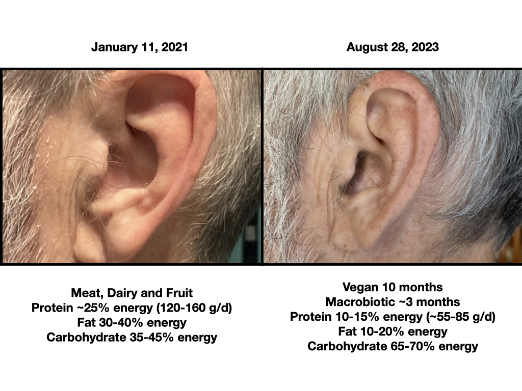 Psoriasis Animal-based vs Macrobiotic left ear