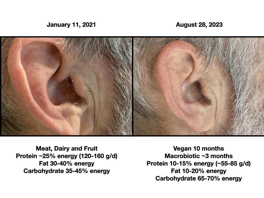 Psoriasis animal based vs macrobiotic right ear corrected